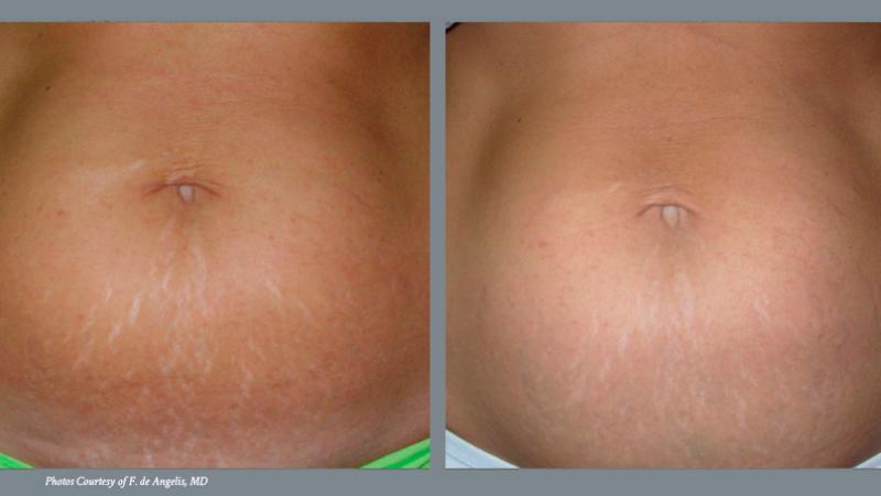 Stretch Mark Reduction | St. Peter's Health